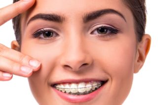 donna con apparecchio ai denti