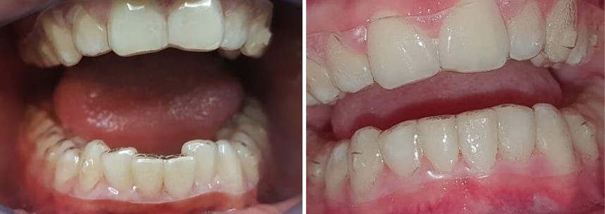 allineatori invisibili prima e dopo il trattamento