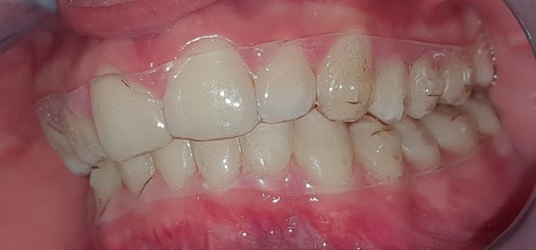 allineatori invisibili