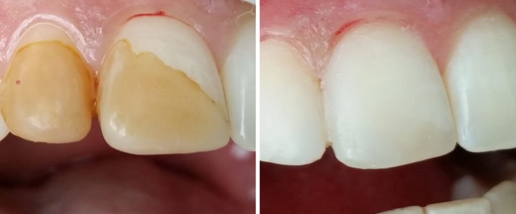 trattamento prima e dopo