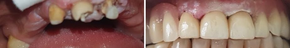 protesi con attacchi prima e dopo