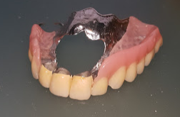 protesi scheletrata con attacchi