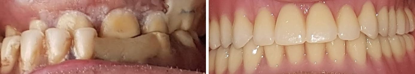 riabilitazione protesica