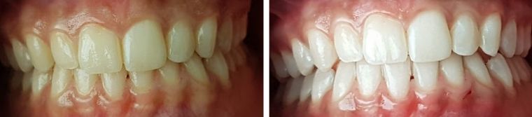 denti a confronto dopo trattamento sbiancamento dentale