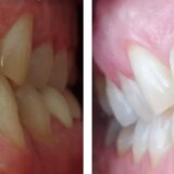 confronto prima e dopo sbiancamento