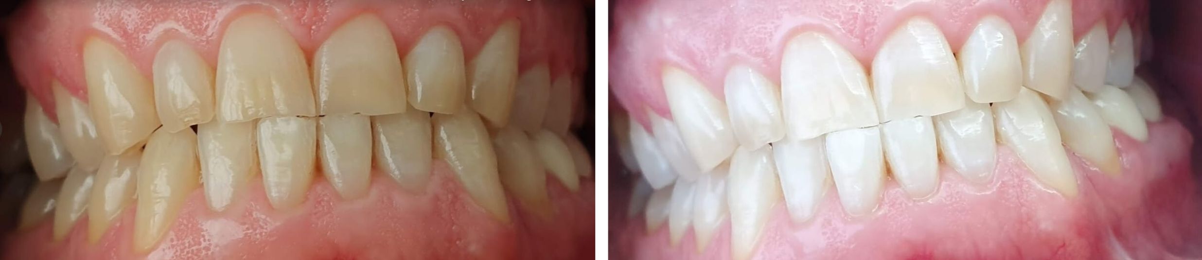 confronto prima e dopo sbiancamento